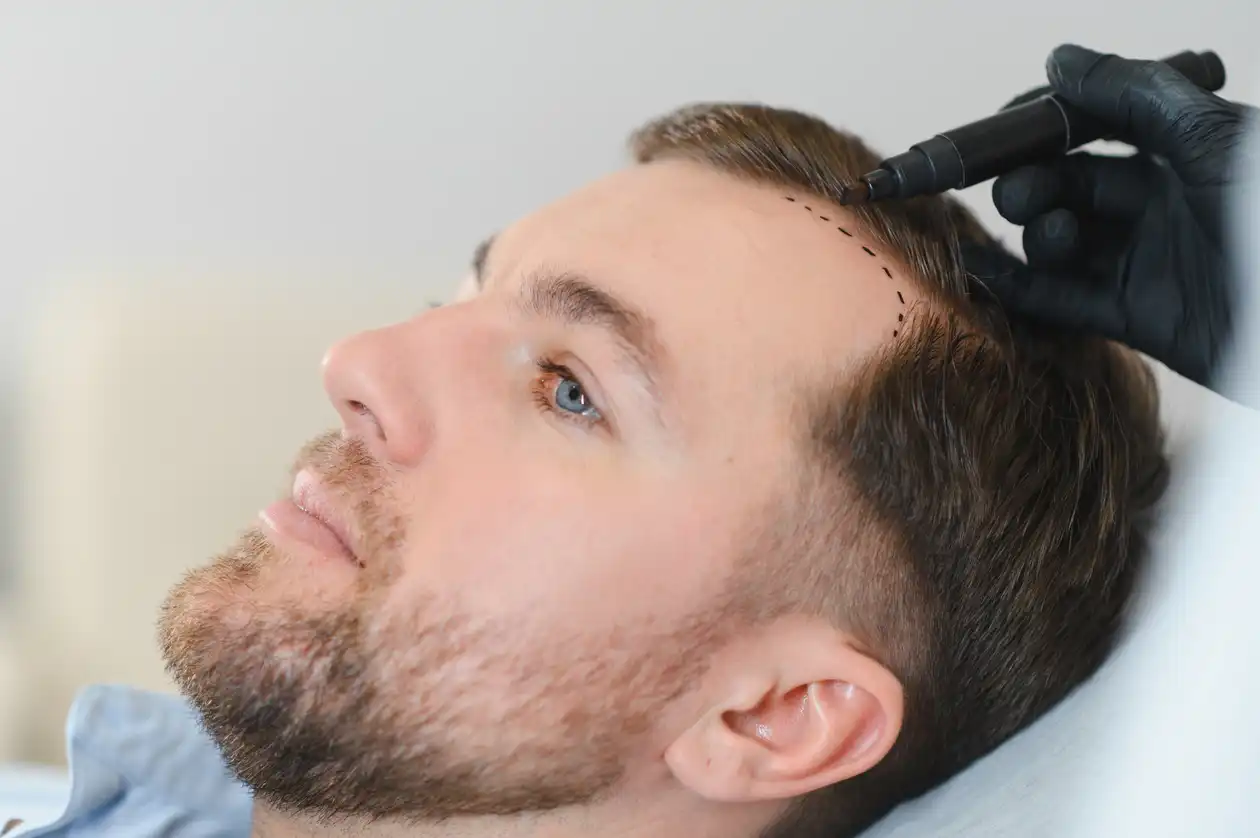 Male Hair Restoration