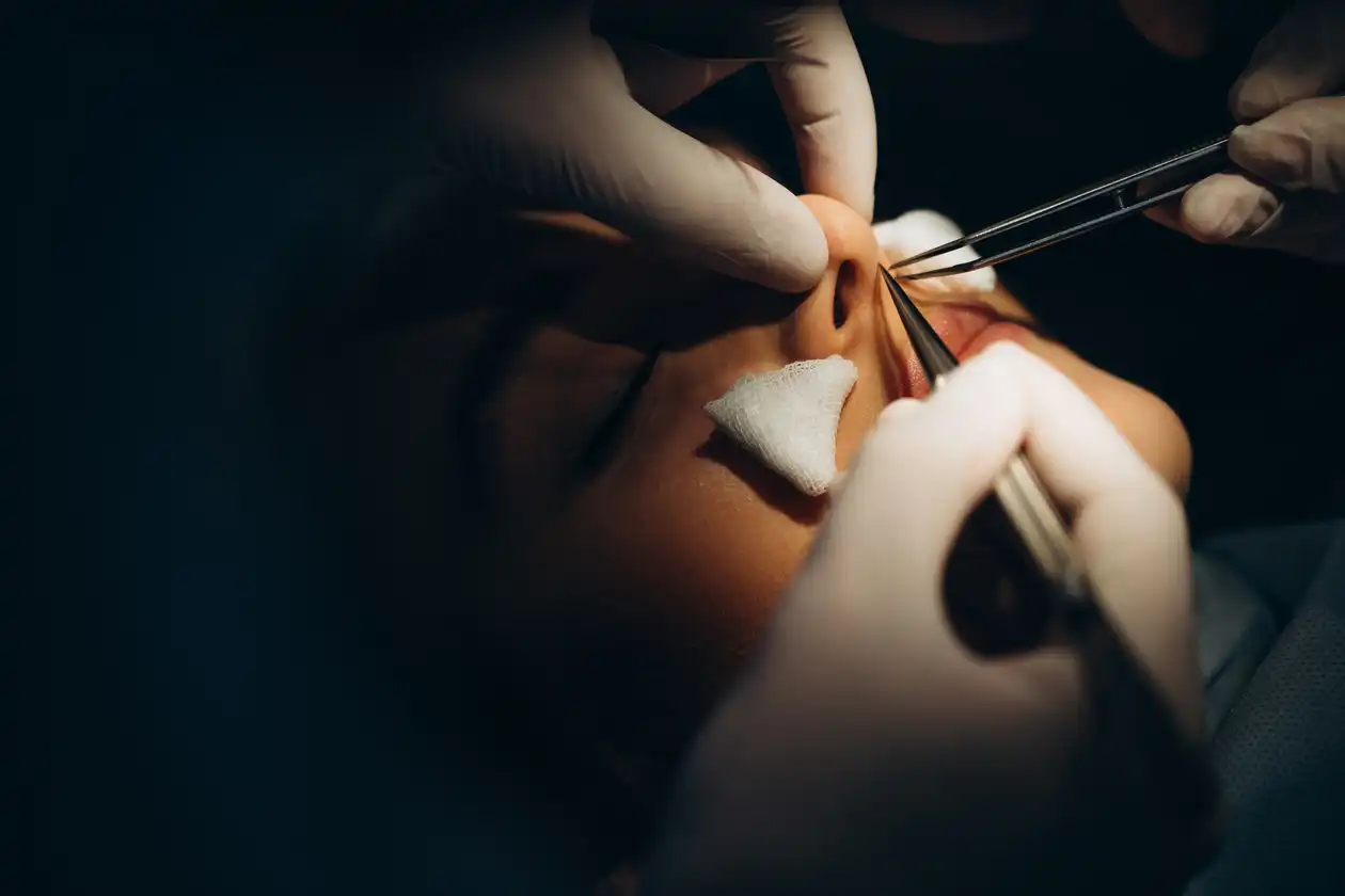 Rhinoplasty (Nose Job)